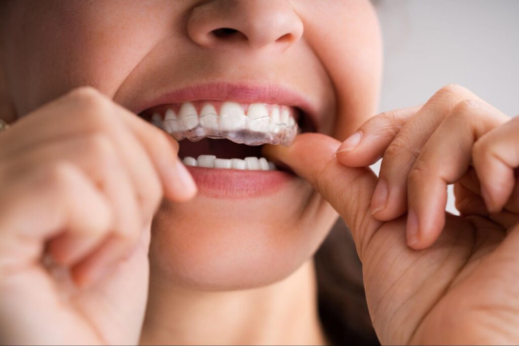 Why Spark Aligners Are Better Than Other Aligners
